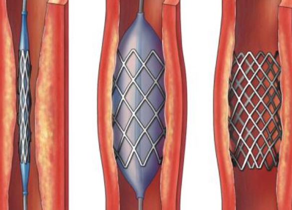 好消息！700元冠脈支架來了帶量采購結果在甘肅省正式落地執行